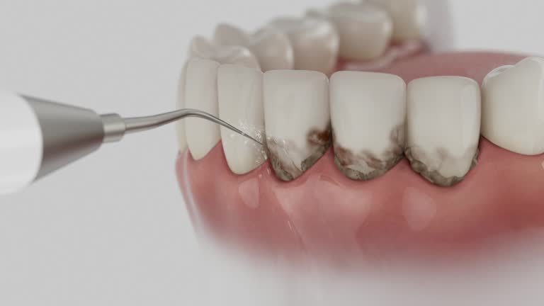 Trusted Dental Crowns And Bridges service in Fairland, MD - Dentist Open Now